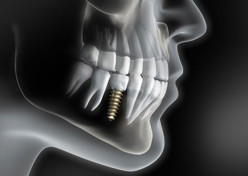The Advantages of Single Tooth Dental Implants in Gurgaon Over Other Options The Advantages of Single Tooth Dental Implants in Gurgaon Over Other Options