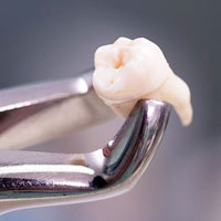 Tooth Extraction in Delhi