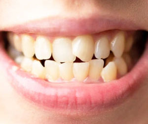 Crowded Teeth