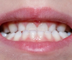 upper teeth