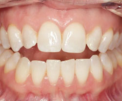 lower teeth