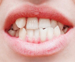 lower teeth